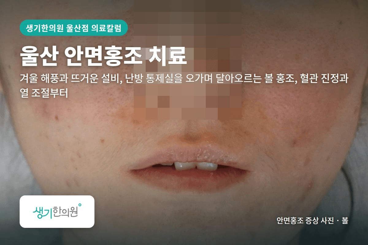 볼 안면홍조 증상 사진과 문구 「울산 안면홍조 치료, 겨울 해풍과 뜨거운 설비, 난방 통제실을 오가며 달아오르는 볼 홍조, 혈관 진정과 열 조절부터 · 생기한의원 울산점」