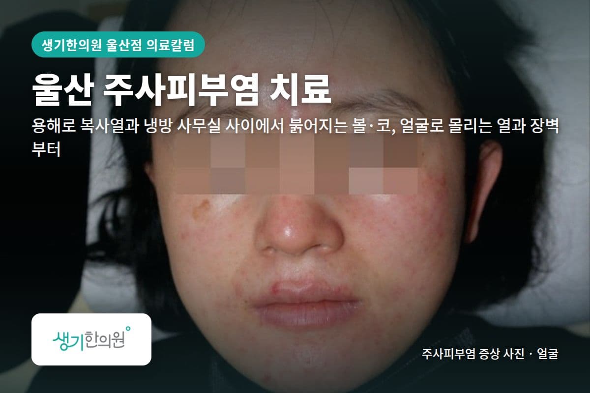 얼굴 주사피부염 증상 사진과 문구 「울산 주사피부염 치료, 용해로 복사열과 냉방 사무실 사이에서 붉어지는 볼·코, 얼굴로 몰리는 열과 장벽부터 · 생기한의원 울산점」