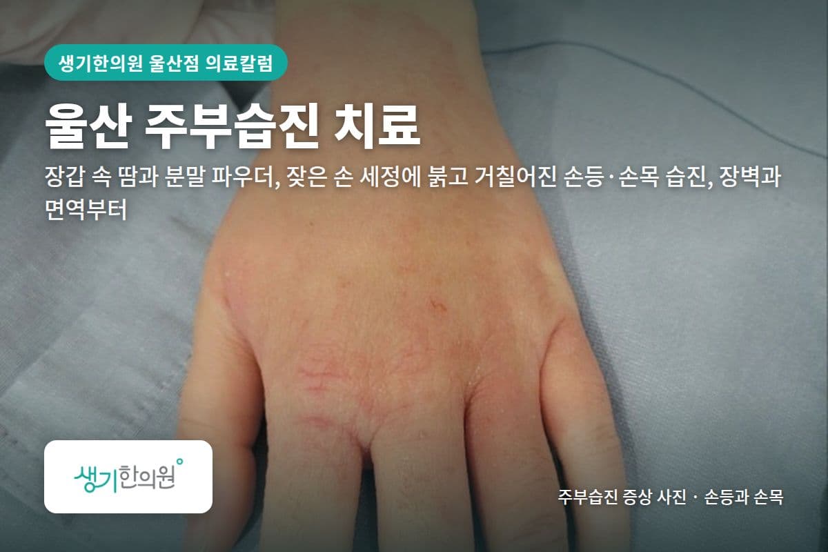 손등과 손목 주부습진 증상 사진과 문구 「울산 주부습진 치료, 장갑 속 땀과 분말 파우더, 잦은 손 세정에 붉고 거칠어진 손등·손목 습진, 장벽과 면역부터 · 생기한의원 울산점」