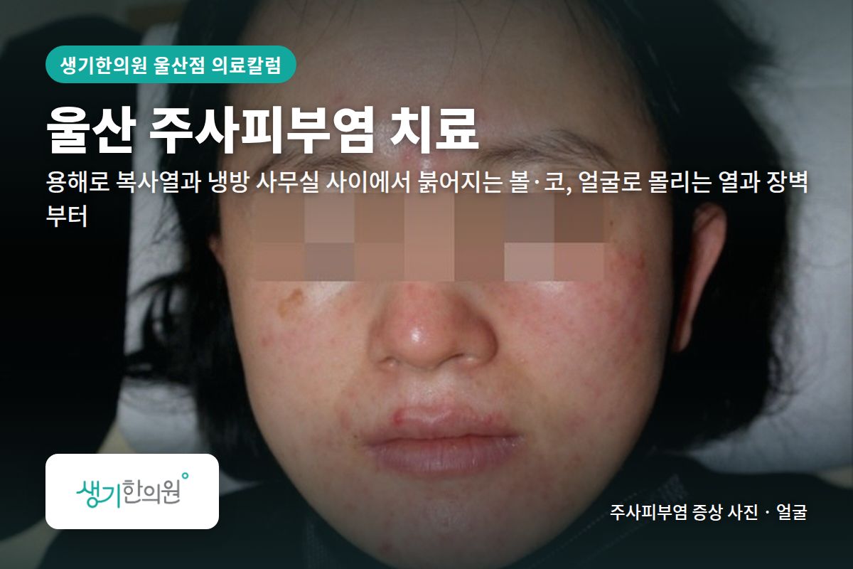얼굴 주사피부염 증상 사진과 문구 「울산 주사피부염 치료, 용해로 복사열과 냉방 사무실 사이에서 붉어지는 볼·코, 얼굴로 몰리는 열과 장벽부터 · 생기한의원 울산점」